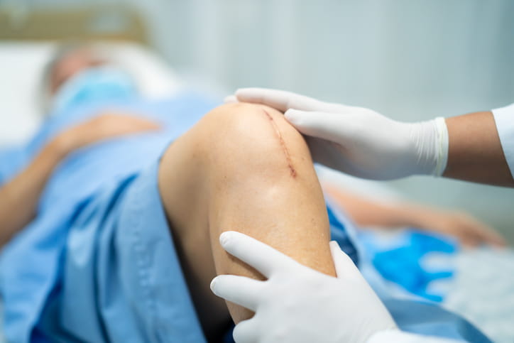 A doctor examining a scar on a patient from a knee joint replacement surgery. 
