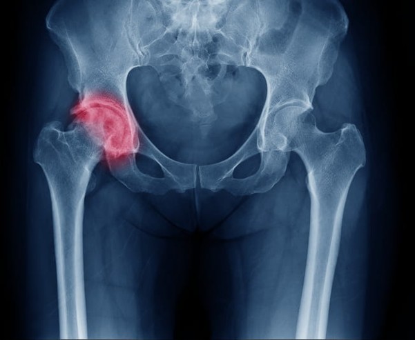 An X-ray showing a broken hip.