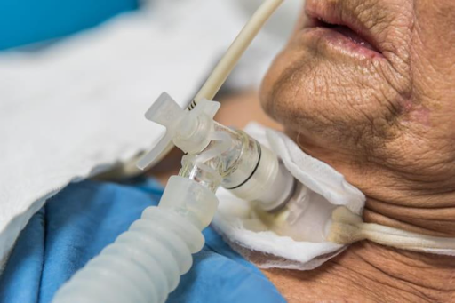 A patient with a tracheostomy and ventilator. 