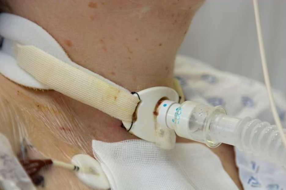 Tracheotomy and Tracheostomy