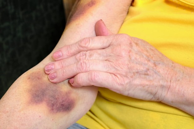 A senior with bruises on their arm.